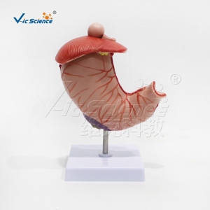 VIC-V53大号病理胃人体解剖病理教学模型