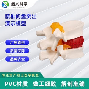 椎间盘突出演示模型11*10*7.6CM模型教学展示教具