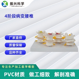 4阶段病态腰椎比较模型 厂家供应医学教学器材模型教学展示教具