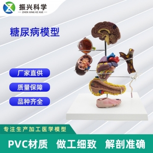 糖 尿 病模型工厂 医学教材糖 尿 医疗教学讲解科室器材