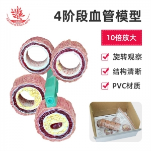 血管模型人体四阶段病理血管标本心内科医患沟通演示血管阻塞模型