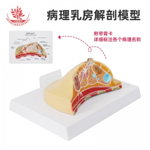 人体病理乳房模型病理解剖结构模型乳房常见疾病人体乳房病理模型