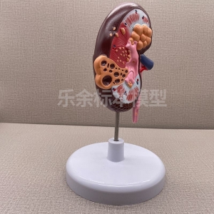 供应ZM2042肾脏囊 肿解剖模型生物教学模型带底座医患交流模型